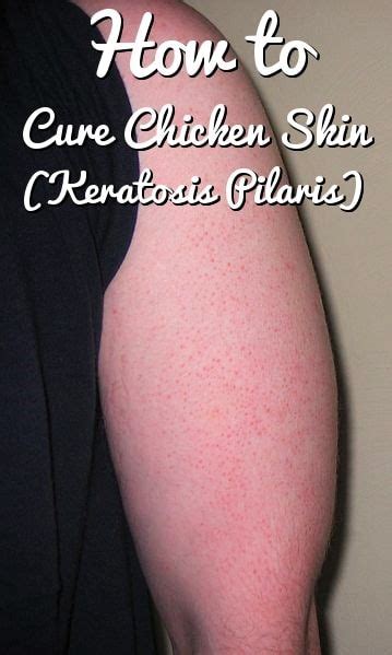 Keratosis Pilaris On Arms Chicken Skin Condition Keratosis Pilaris