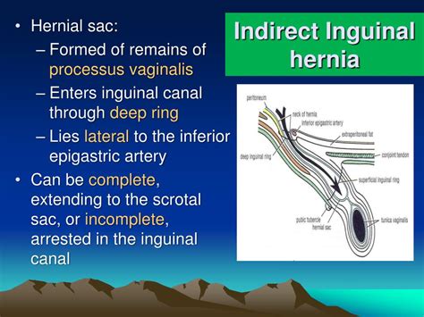 Direct Inguinal Hernia By Definition The Hernia Enters The Inguinal