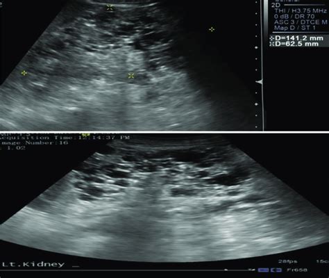 Ultrasound Imaging Reveals That Both Kidneys Are Enlarged With Multiple