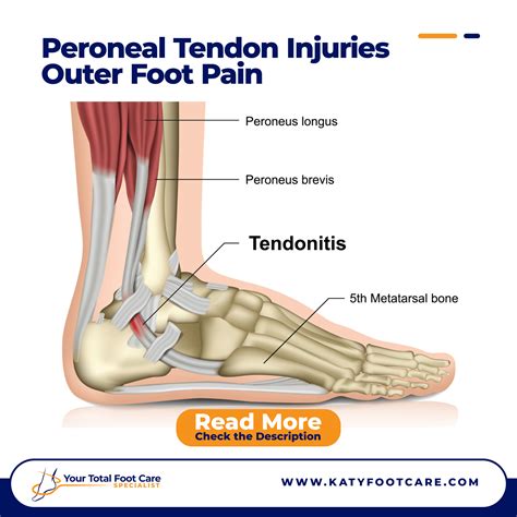 Peroneal Tendon Injuries Outer Foot Pain