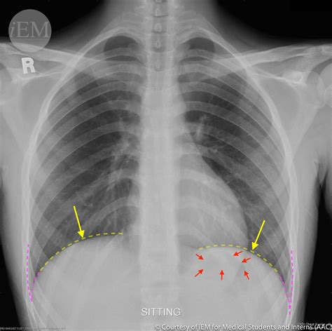 3366 Normal Pa Chest X Ray Diaphragma Structures Flickr