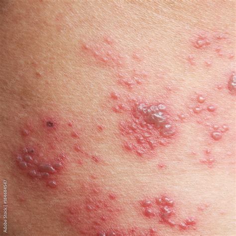 Raised Red Bumps And Blisters Caused By Shingles On Skin Stock Foto