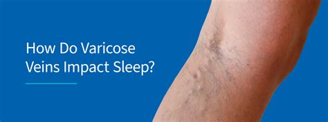 How To Sleep With Varicose Veins Pain Relief