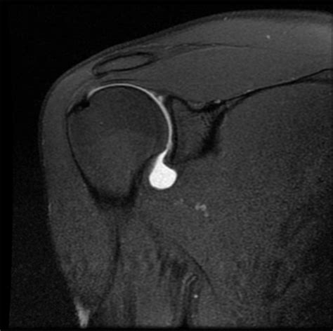 Coronal Mri Image Of The Shoulder Showing Extravasation Open I