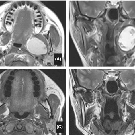 Mr Imaging Of Case 2 A Preoperative T1‐weighted Horizontal Section
