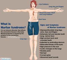 9 Marfan Awareness Ideas Marfan Syndrome Syndrome Genetic Disorders