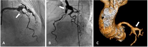 Frontiers Coronary Artery Aneurysms A Review Of The Epidemiology