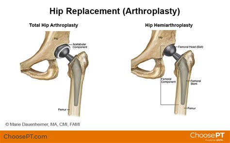Bipolar Hemiarthroplasty Vs Total Hip Replacement