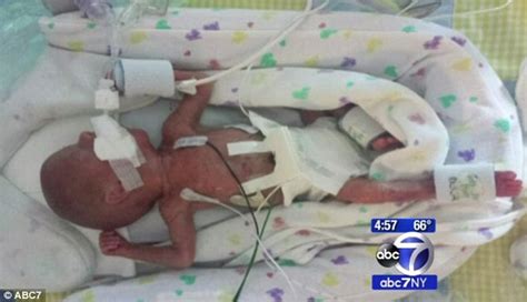 Mother Gives Birth To Twin But His Brother Is Still In