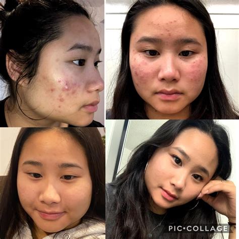 Face Full Of Acne To Kinda Clear Skin Intermittentfasting