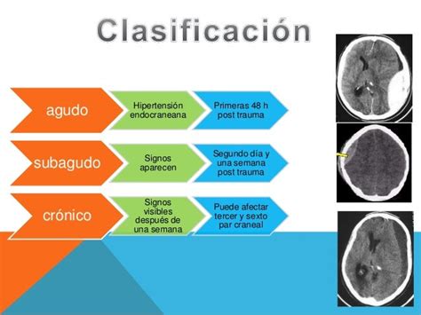 Hematoma Epidural Subdural Y Parenquimatoso Wrocawski Informator