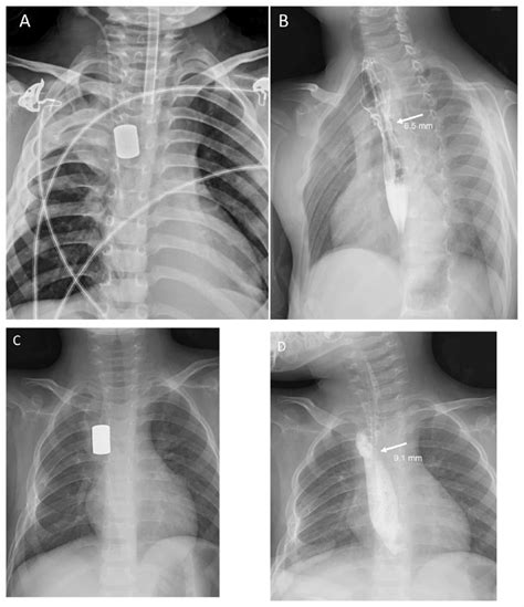 Chest Radiography For The Two Patients A Radiographic Approximation