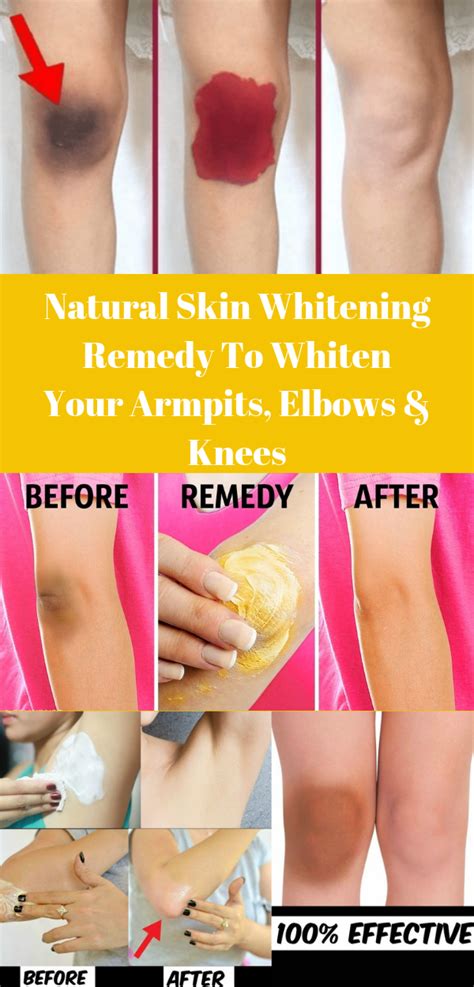 Natural Skin Whitening Remedy To Whiten Your Armpits Elbows And Knees