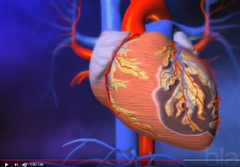 Video comentado Así se produce un infarto de miocardio Cirugía Cardiovascular Sevilla Dr
