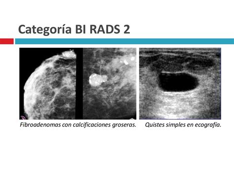 Categorías Bi Rads En Los Informes Mamográficos