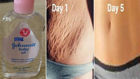 World S Best Remedy For Fast Stretch Mark Removal In Days Remove
