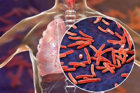 Check spelling or type a new query. Penyakit Tuberkulosis Pekerja Asing - KLINIK DR HASBI