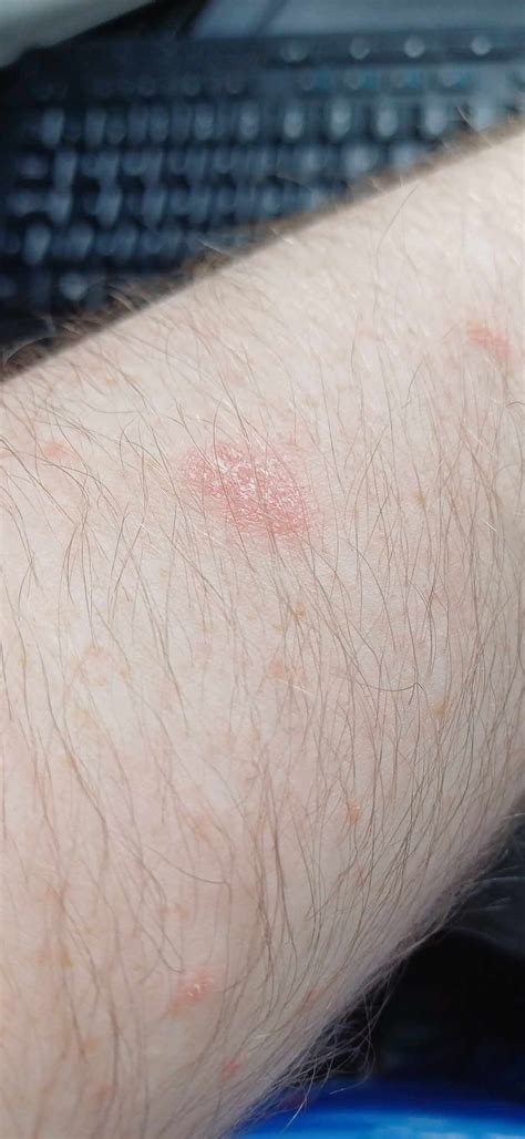 Red Scaly Patches And Smaller Red Bumps Suddenly Appearing On Arms