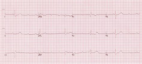 The Boring Guide To Ecgs Fascicular Blocks Canadiem