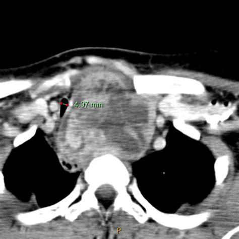 Pdf Surgical Video On The Sternotomy Sparing Medial Approach