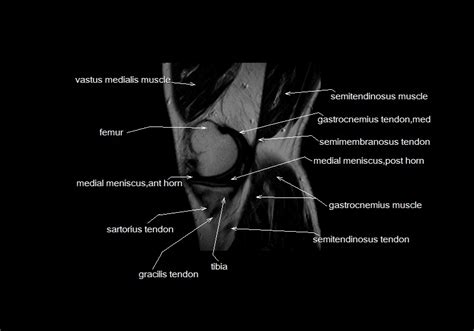 Scroll through the structures to understand the anatomy. mri knee anatomy | knee sagittal anatomy | free cross ...