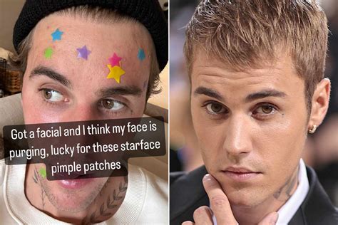 Justin Bieber Shares Post Facial Selfie Wearing Pimple Patches