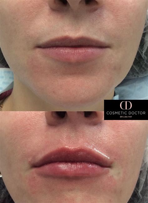Before After Lip Fillers Cosmetic Doctor Dublin Cosmetic Doctor Dublin