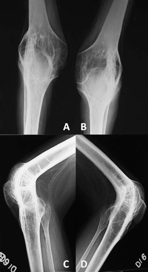 Knee Joint X Ray Anatomy