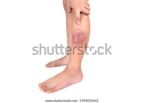 Fungal Infection Called Tinea Corporis In Leg Widespread Ringworm Over