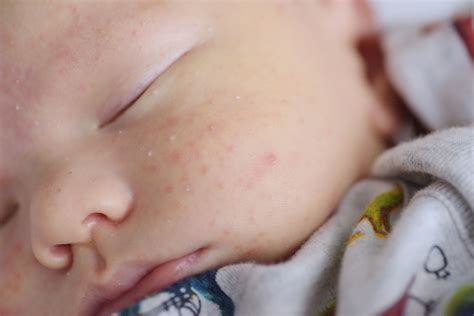 Erythema Toxicum Neonatorum In Newborns Causes Symptoms And Treatment Being The Parent