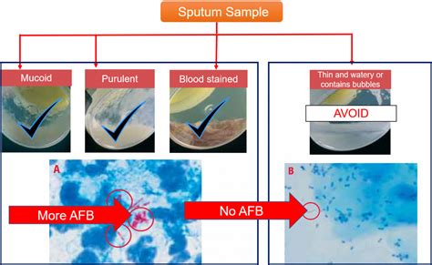 Sputum Smear Preparation Selecting The Best Portion Of The Sputum Specimen For Microscopy