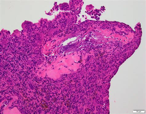 Pathology Outlines Aneurysmal Bone Cyst