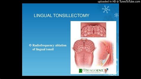 Radio Frequency Ablation For Lingual Tonsil Youtube