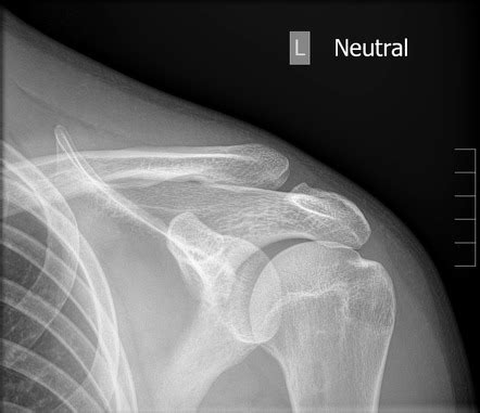 Acromioclavicular Joint Zanca View Radiology Reference Article Radiopaedia Org