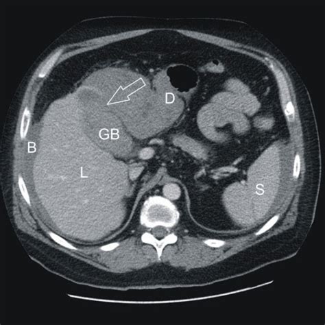 Computed Tomography Ct Of The Abdomen A Axial Slice L Liver Gb