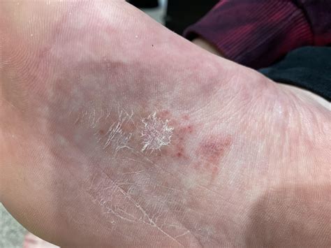 Rash On Bottom Of Foot And Similar Red Dots All Over Feet What Are
