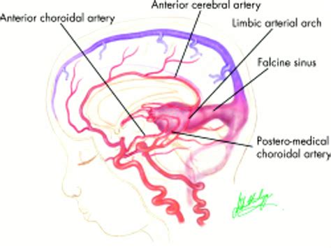 Labbé vein synonyms, labbé vein pronunciation, labbé vein translation, english dictionary definition of labbé vein. VEIN OF GALEN MALFORMATIONS | Journal of Neurology ...