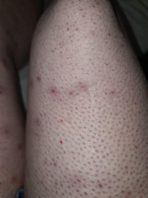 Small Bruises Up Legs That Wont Go Away Rausskincare