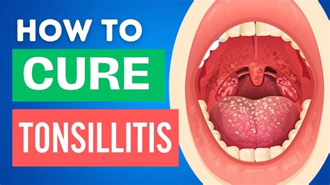 10 Home Remedies For Tonsillitis Tonsillitis Treatments At Home Youtube