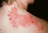 Home Remedies Herpes Zoster Images