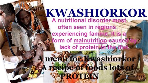 Kwashiorkor Menu For Kwashiorkor Children Protein Malnutrition Youtube