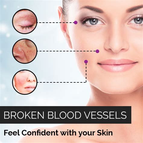 The Best 28 Broken Blood Vessel On Face Treatment Marrytrendq
