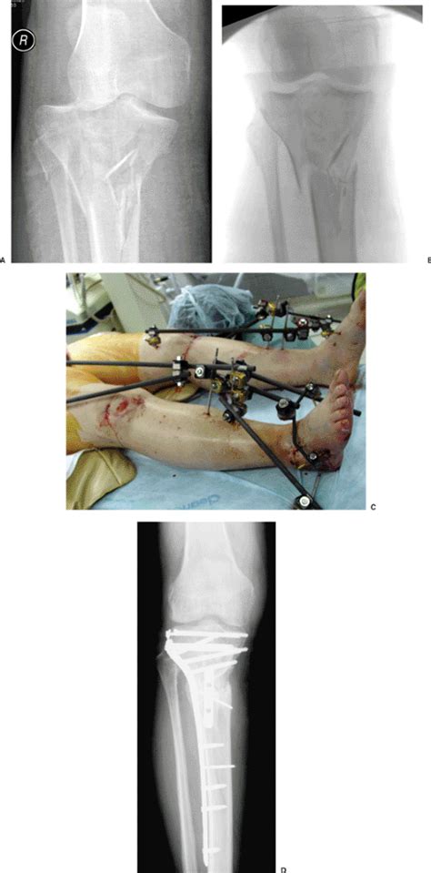 Tibial Plateau Fractures Open Reduction Internal Fixation Teachme
