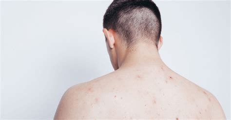 Back Acne Common Causes And How To Treat It Australian Skin Clinics