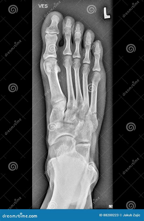 Foot Medical Xray Lower Limb Bones Stock Image Image Of Broken