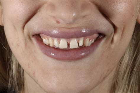 10 Direct Composite Veneers To Completely Transform The Smile Maison Dental
