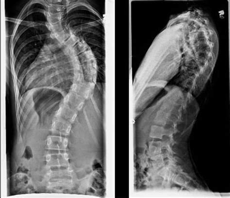 Scoliosis X Ray Before And After