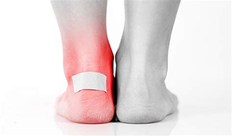 Podiatry Associates Of Belleville Blisters Can Be Caused By Excessive