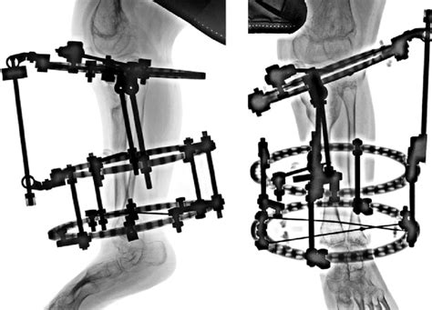 Ap And Lat Radiographs Of The Left Tibia Demonstrating Gradual