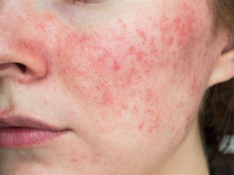 Rosacea Facial Redness Skin Conditions Leicester